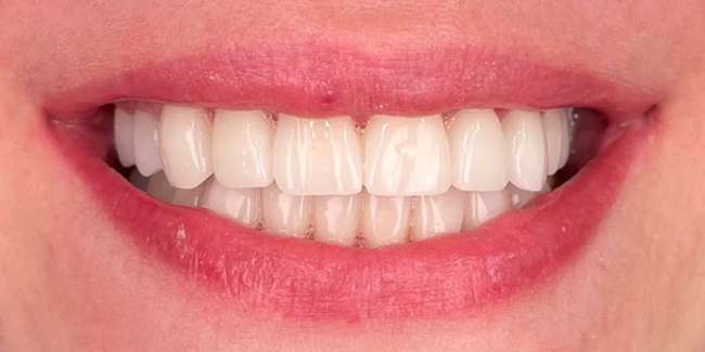 After Veneers
