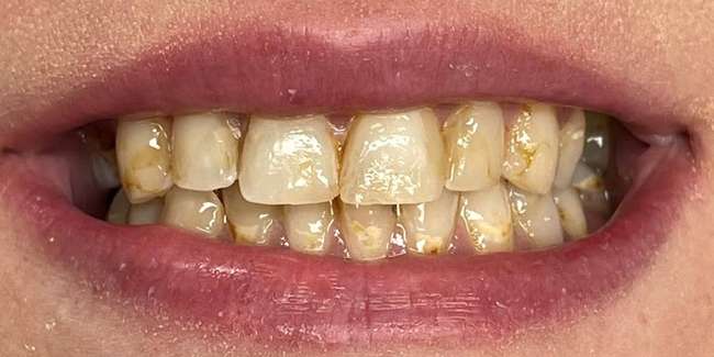 Before Veneers